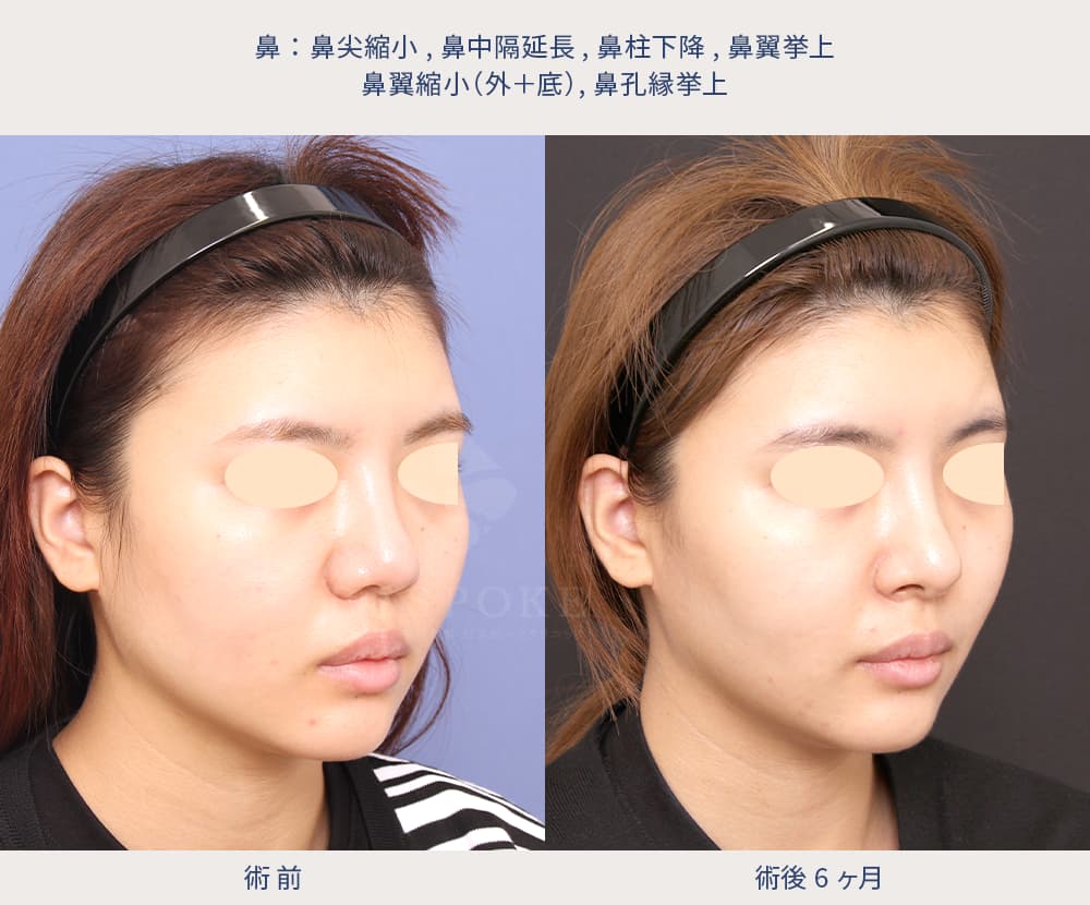 五反田医師による鼻整形の症例写真