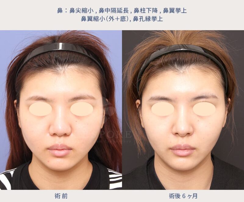 五反田医師による鼻整形の症例写真-3