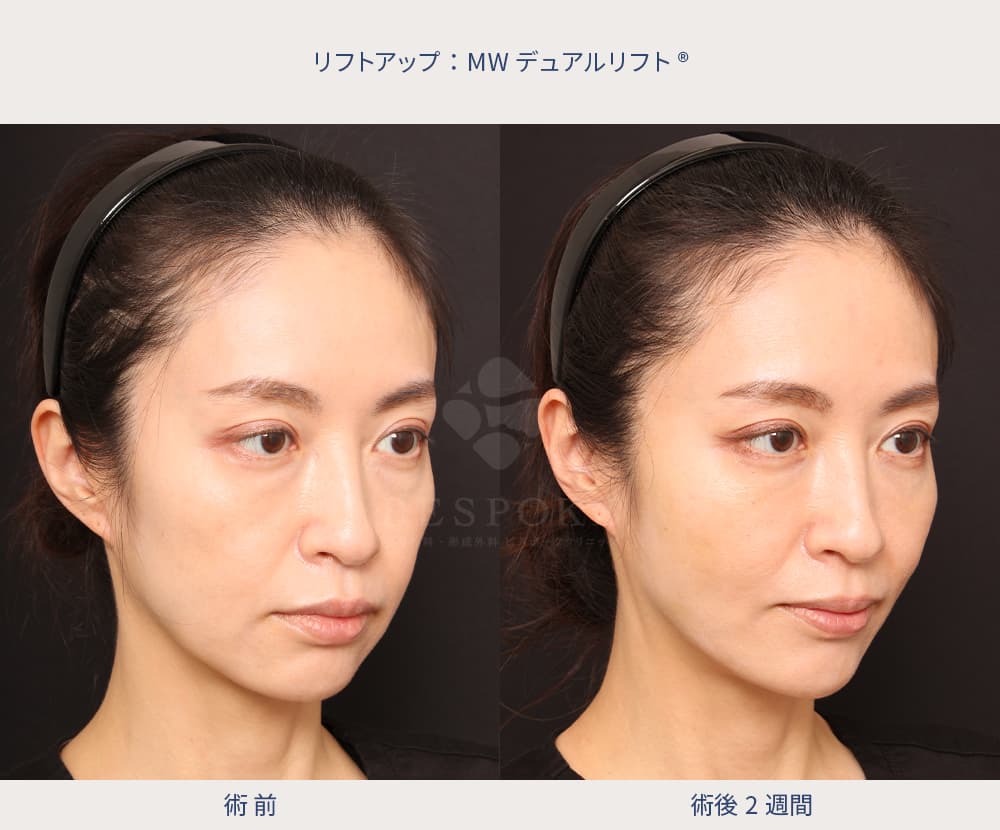 糸リフトで中顔面が短くなった症例写真