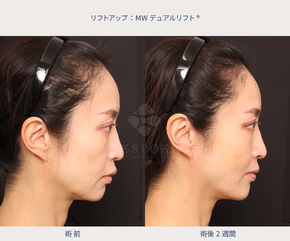 糸リフトで中顔面が短くなった症例写真