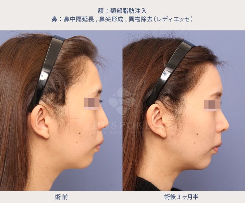 室医師による鼻の美容整形の症例写真（右側面）