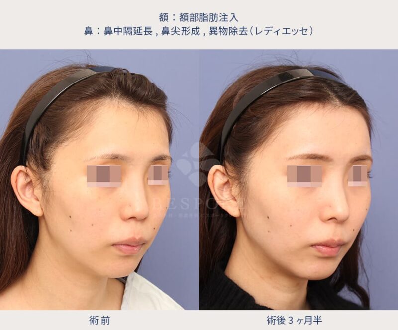 室医師による鼻の美容整形の症例写真（右斜め）