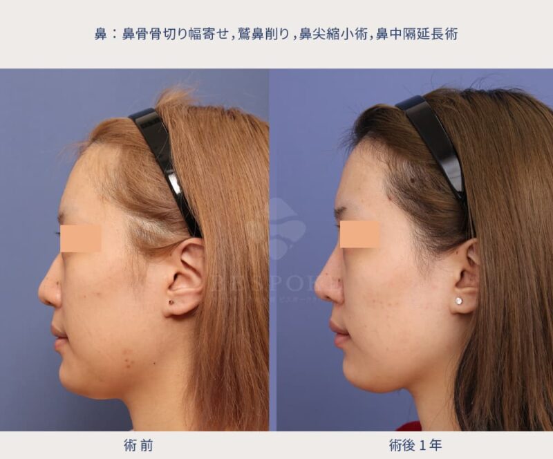 室医師による鼻の美容整形の症例写真（左側面）