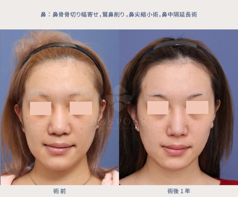 室医師による鼻の美容整形の症例写真（正面-2）