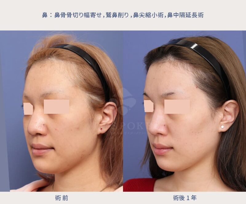 室医師による鼻の美容整形の症例写真（左斜め）