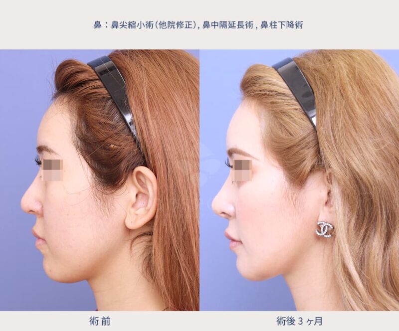 鼻尖縮小術（他院修正）の症例写真（左側面）