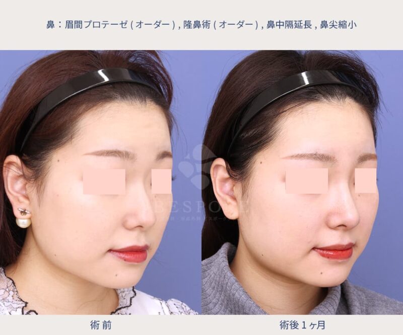 鼻中隔延長術の症例写真（左斜め）