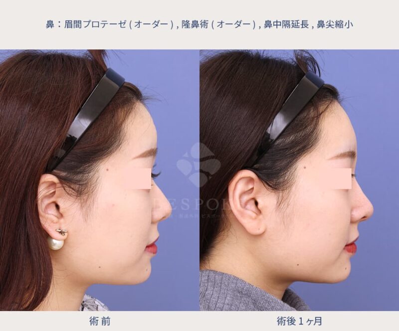 鼻中隔延長術の症例写真（右側面）
