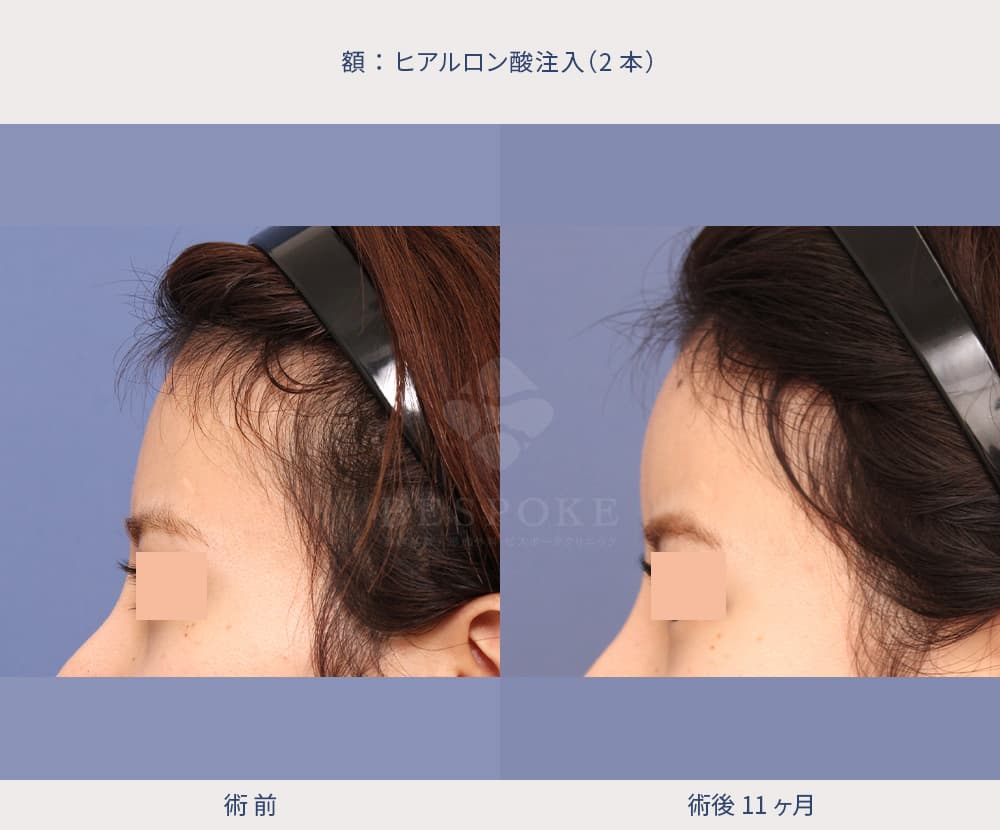 額へのヒアルロン酸注入の症例写真（左側面）