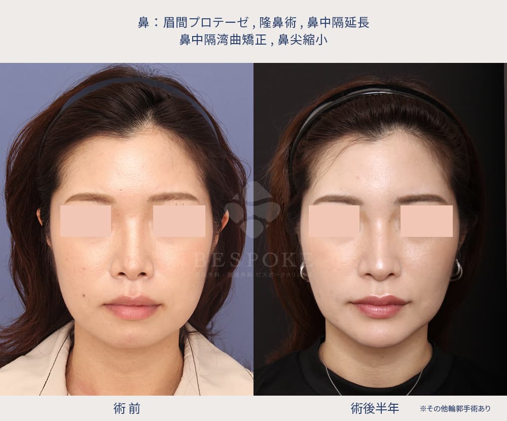 室医師による鼻の美容整形の症例写真（正面）
