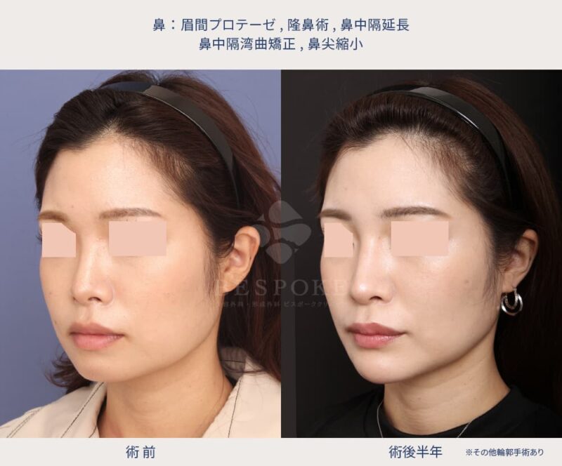 case97_6 室医師による鼻の美容整形の症例写真(左斜め)