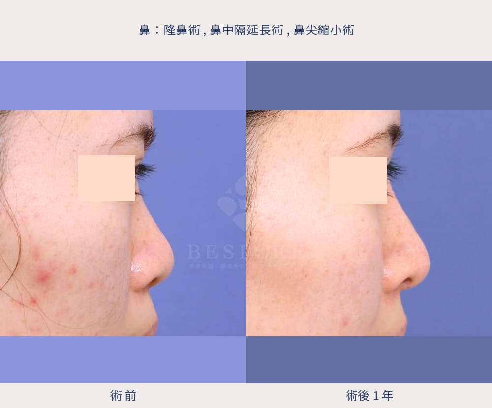 鼻中隔延長術の症例写真（1年後）