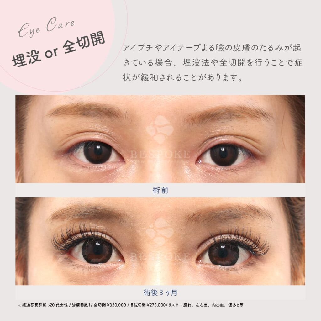 全切開によるたるみ治療の術前術後の写真