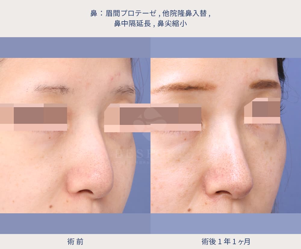 眉間プロテーゼ、隆鼻術、鼻中隔延長、鼻尖縮小の他院修正の症例