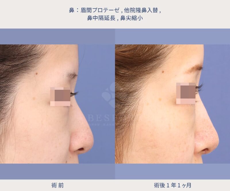 鼻中隔延長術の症例写真（右側面）