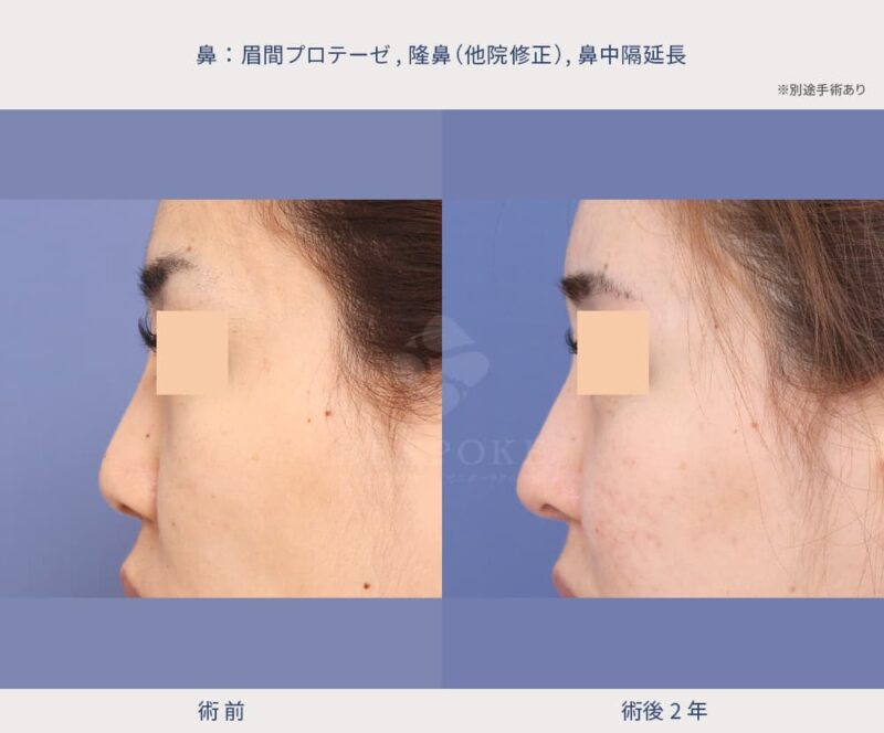 鼻の施術の症例写真（左側面）