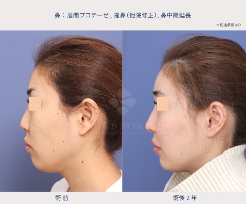 鼻の施術の症例写真（全体3）