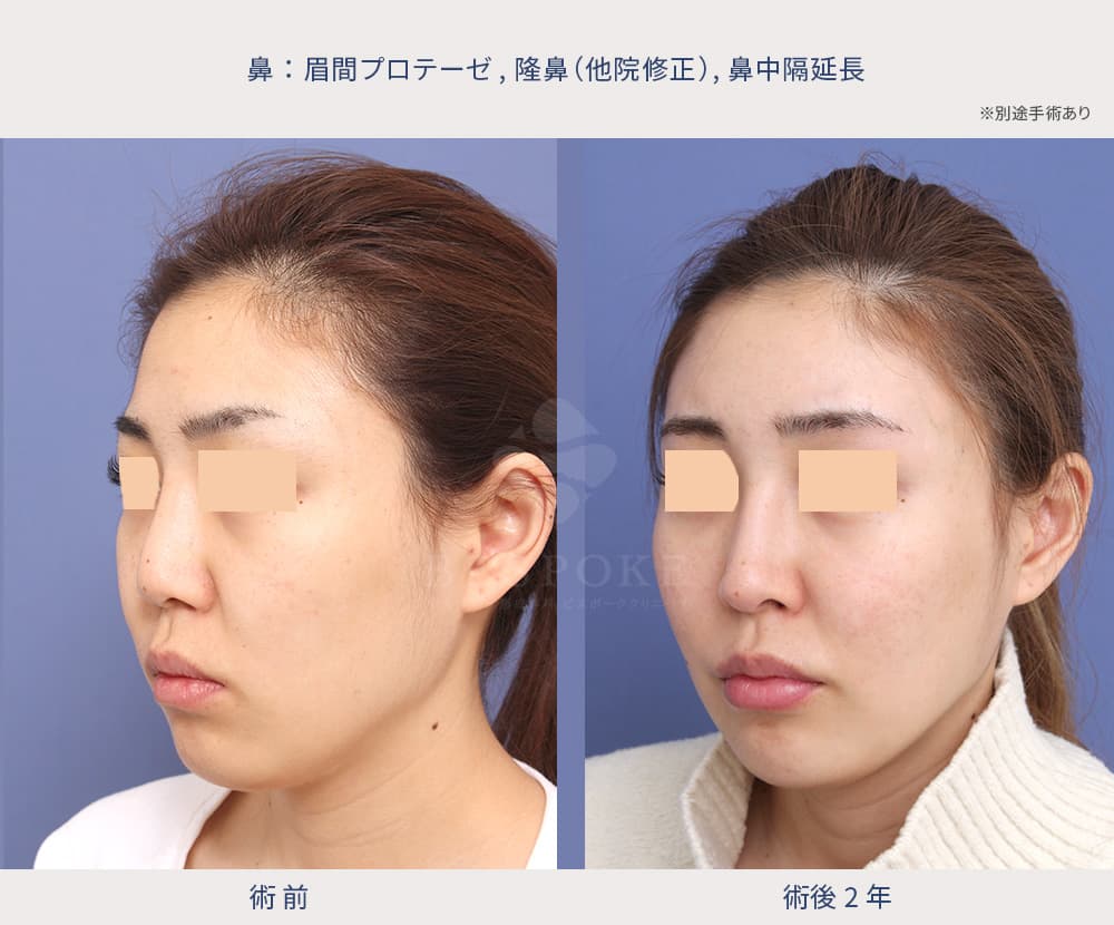 眉間プロテーゼ、隆鼻術、鼻中隔延長術他院修正の症例
