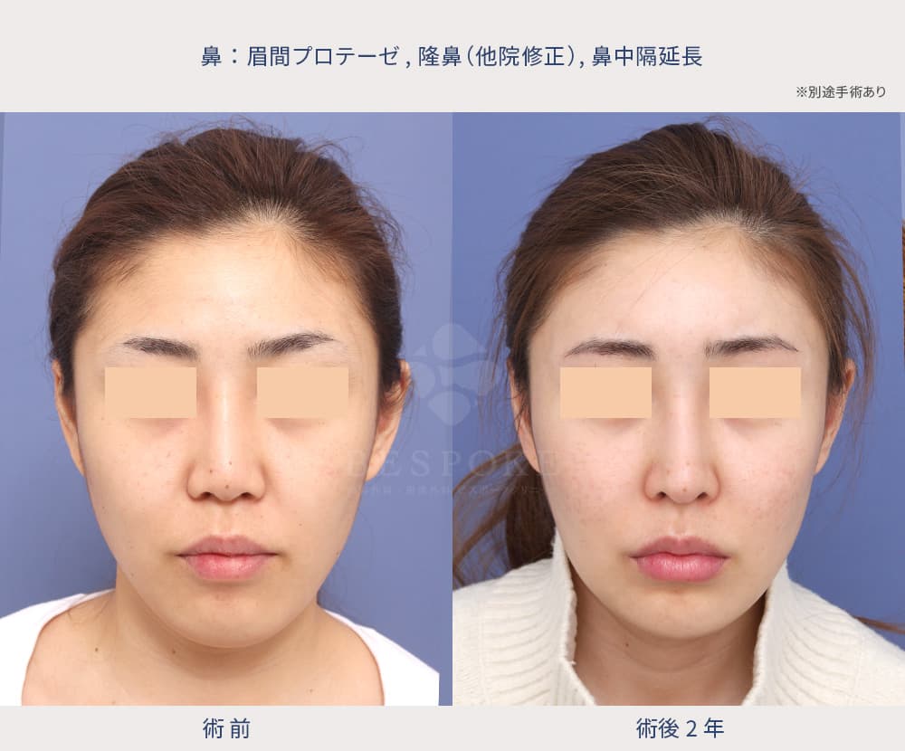 眉間プロテーゼ、隆鼻術、鼻中隔延長術他院修正の症例