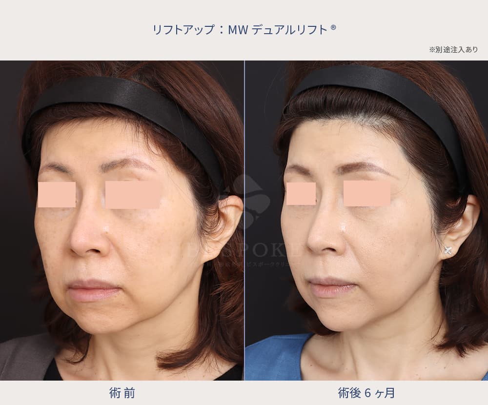 糸リフト症例写真（左斜め）