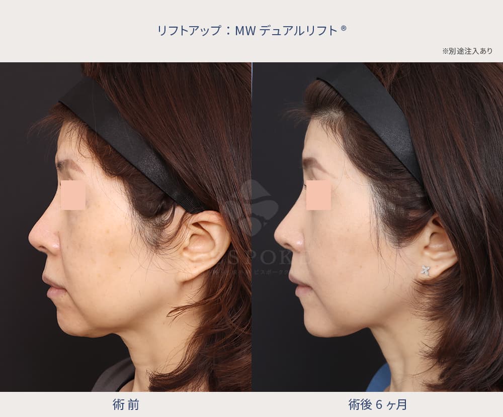 糸リフト症例写真（左側面）