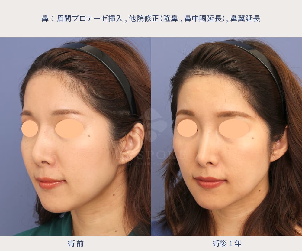 眉間プロテーゼ挿入術、隆鼻術、鼻中隔延長術、鼻翼延長術の他院修正の症例