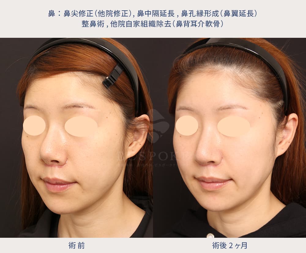鼻尖修正術、鼻中隔延長術、鼻孔縁形成術、他院自家組織除去の他院修正の症例