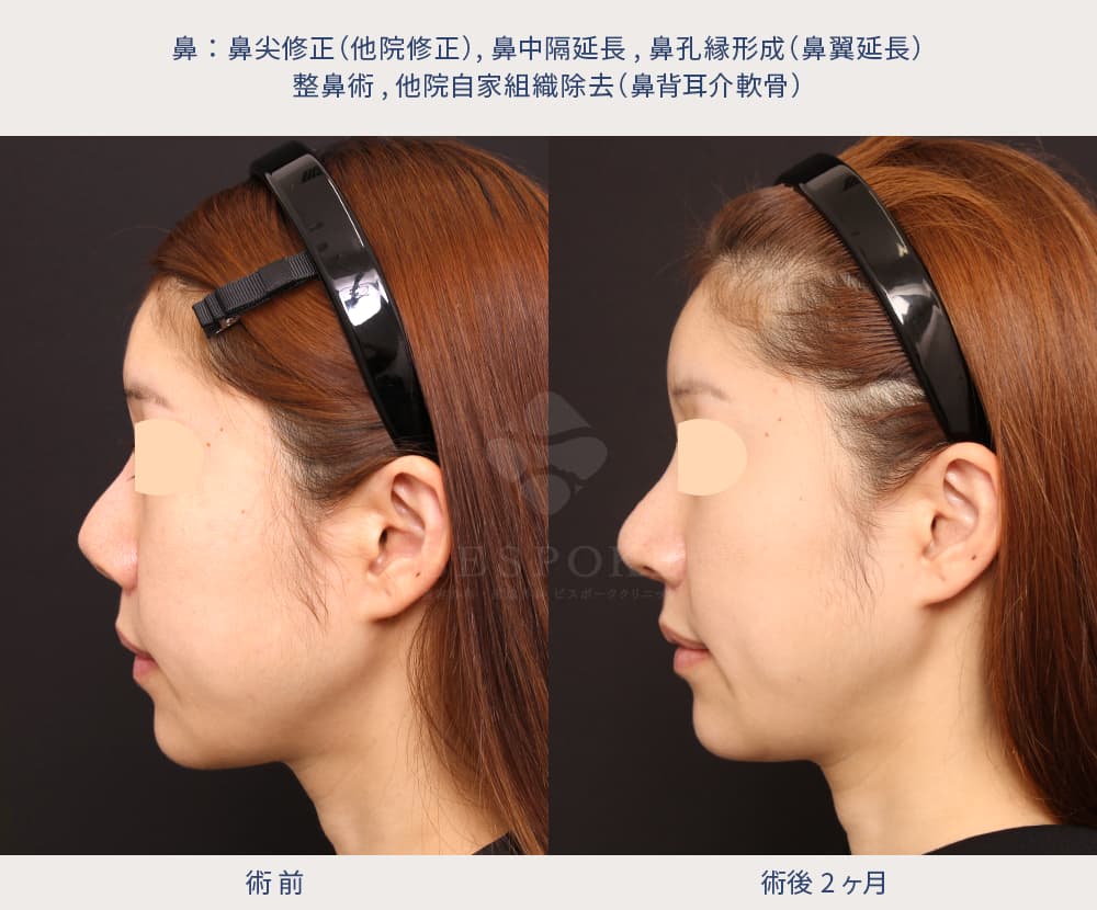 鼻尖修正術、鼻中隔延長術、鼻孔縁形成術、他院自家組織除去の他院修正の症例
