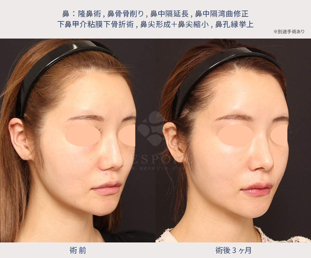 斜め_隆鼻・鼻骨骨削り・鼻中隔延長・鼻中隔湾曲修正・下鼻甲介粘膜下骨折手術・鼻尖形成・鼻尖縮小・鼻孔縁挙上3-2 隆鼻術、鼻骨骨削り、鼻中隔延長、鼻中隔湾曲修正、鼻尖形成、鼻尖縮小、鼻孔縁挙上の症例