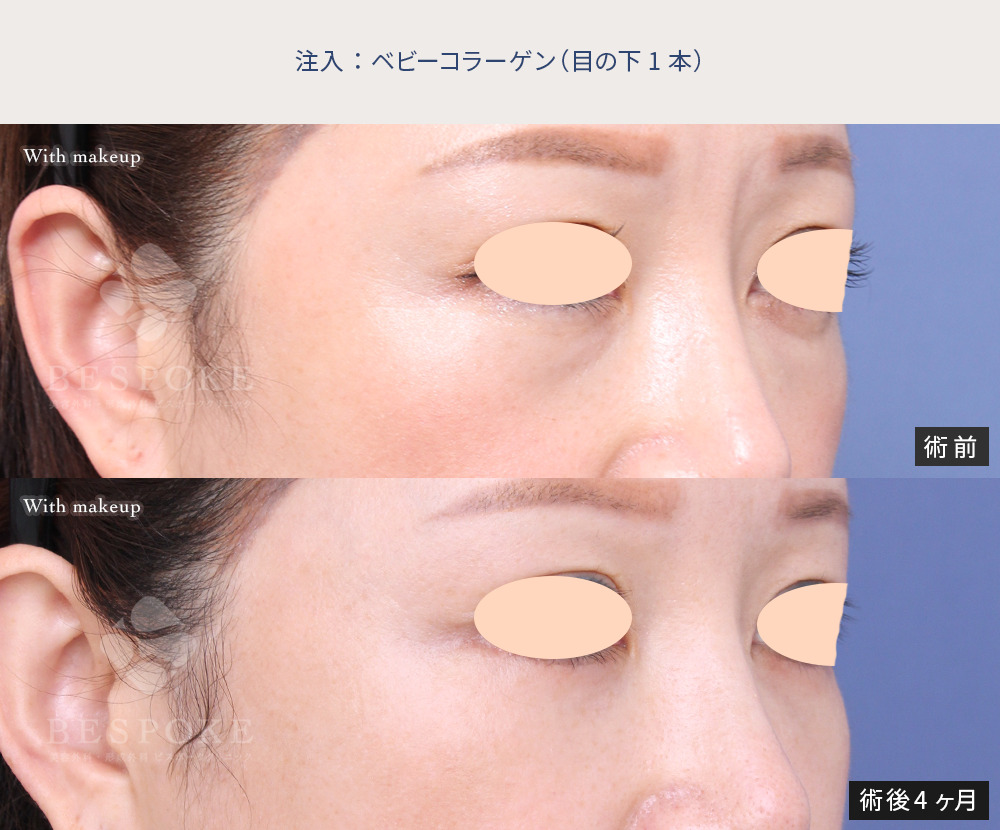 ベビーコラーゲン注入による目の下のクマ、たるみ改善の症例