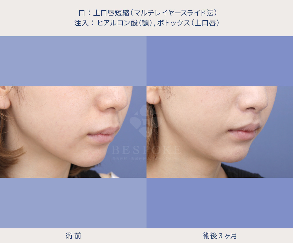 上口唇短縮術（人中短縮術）の症例
