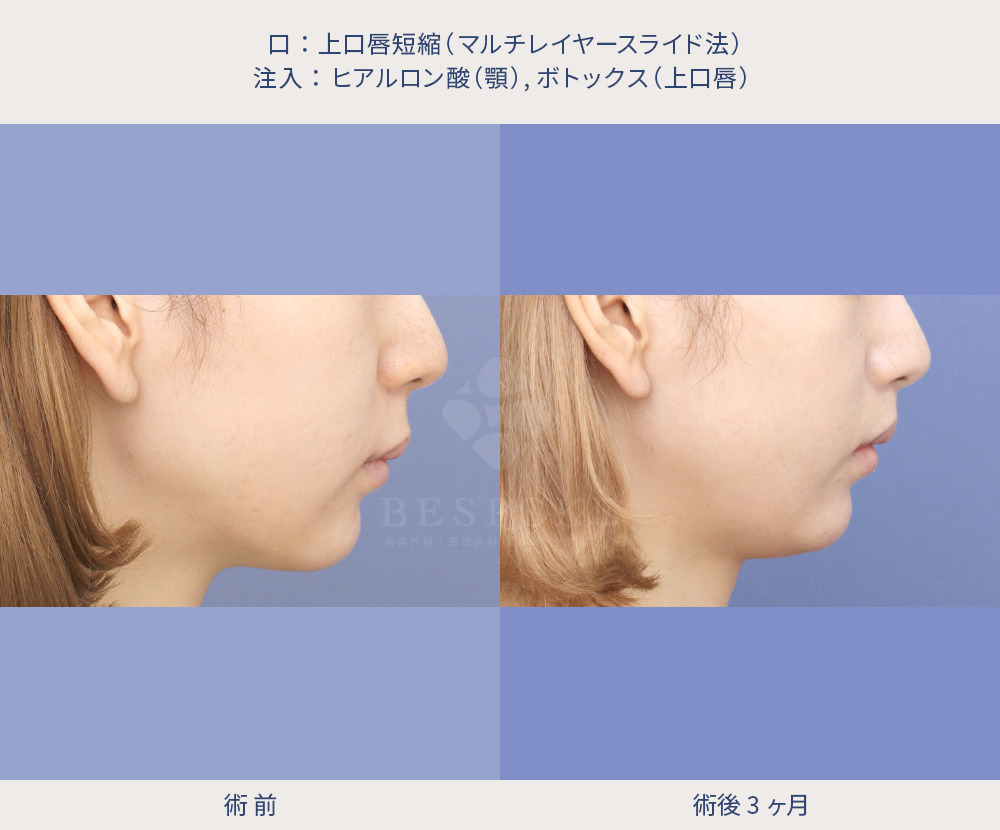 上口唇短縮術（人中短縮術）の症例