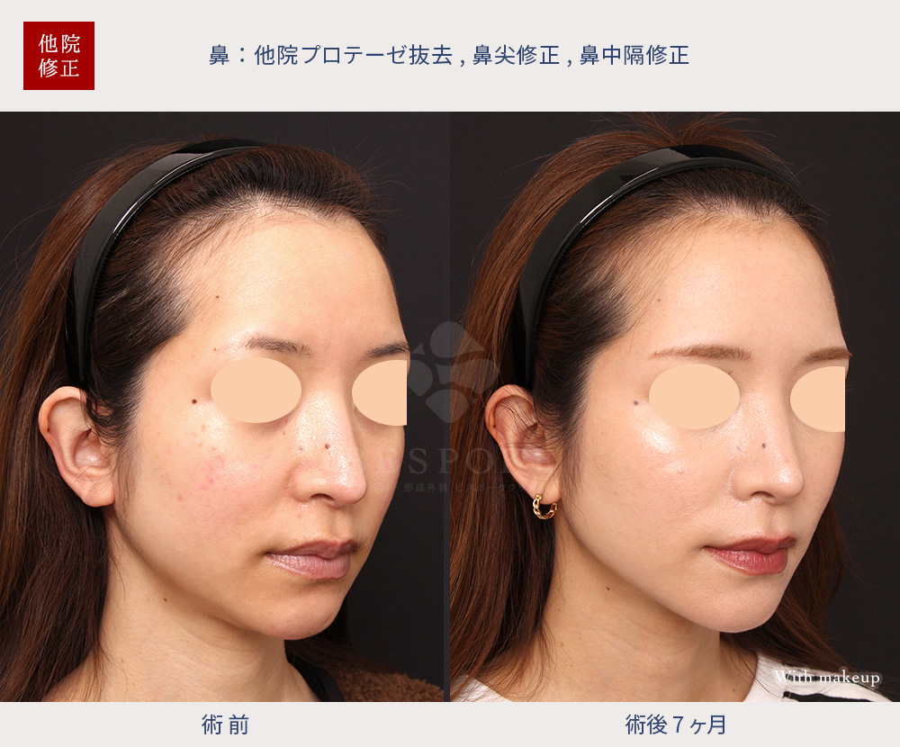 他院プロテーゼ抜去、鼻尖修正、鼻中隔修正の症例