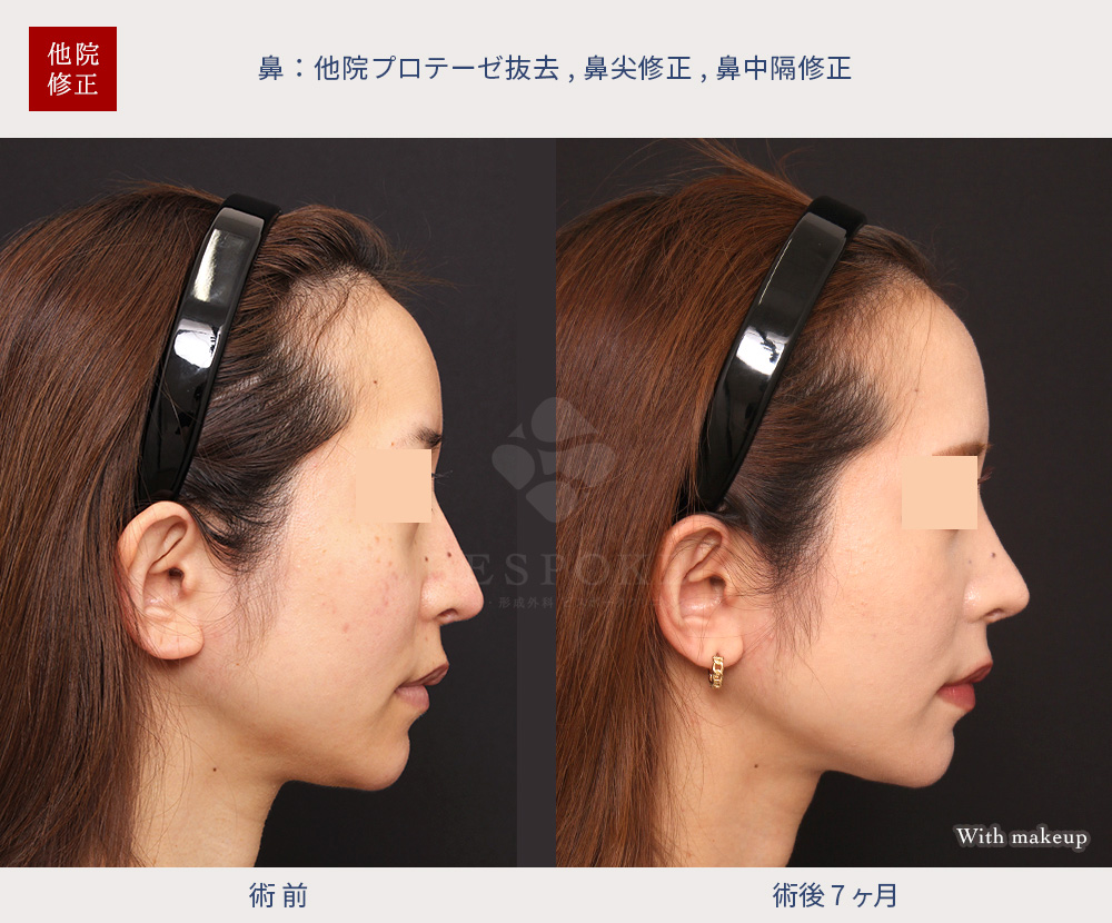 他院プロテーゼ抜去、鼻尖修正、鼻中隔修正の症例