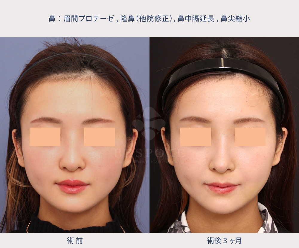 眉間プロテーゼ・隆鼻(他院修正)・鼻中隔延長・鼻尖縮小02-1m 眉間プロテーゼ・隆鼻・鼻中隔延長・鼻尖縮小の他院修正の症例