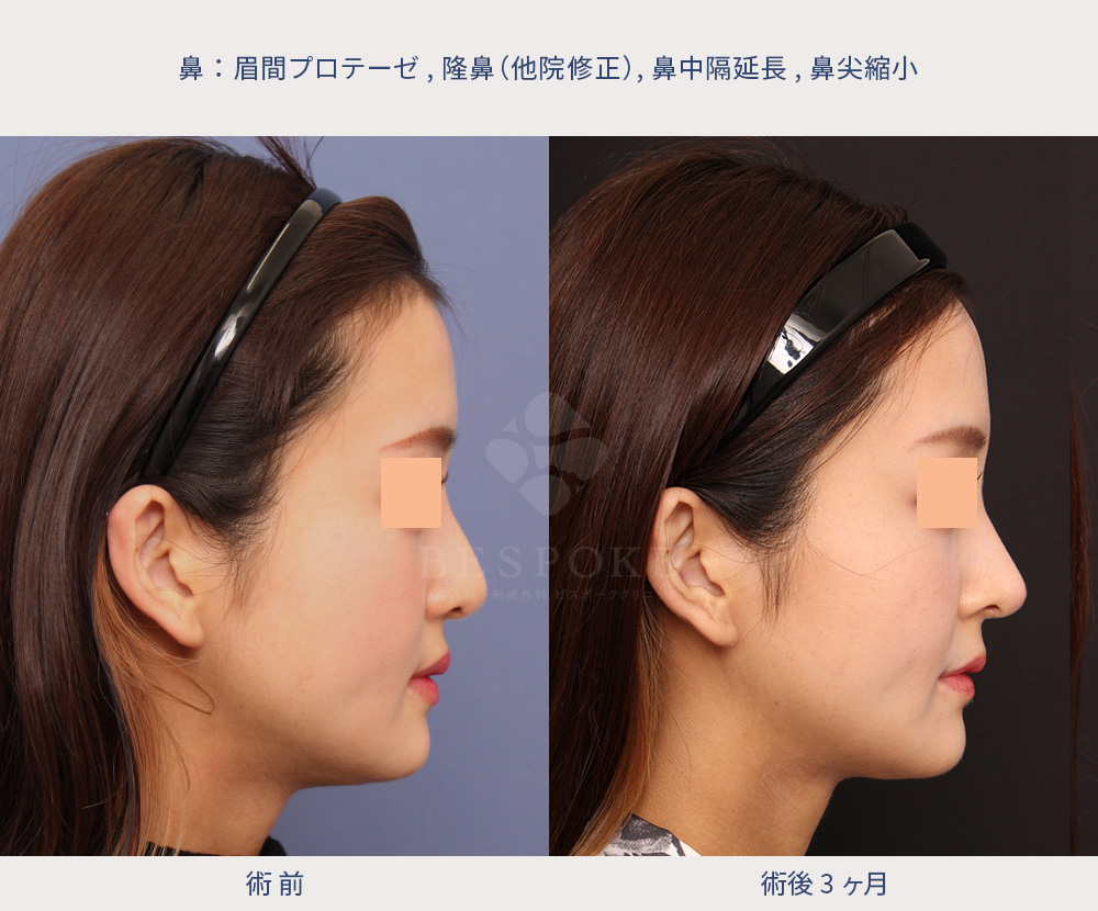 眉間プロテーゼ・隆鼻(他院修正)・鼻中隔延長・鼻尖縮小02-3m 眉間プロテーゼ・隆鼻・鼻中隔延長・鼻尖縮小の他院修正の症例