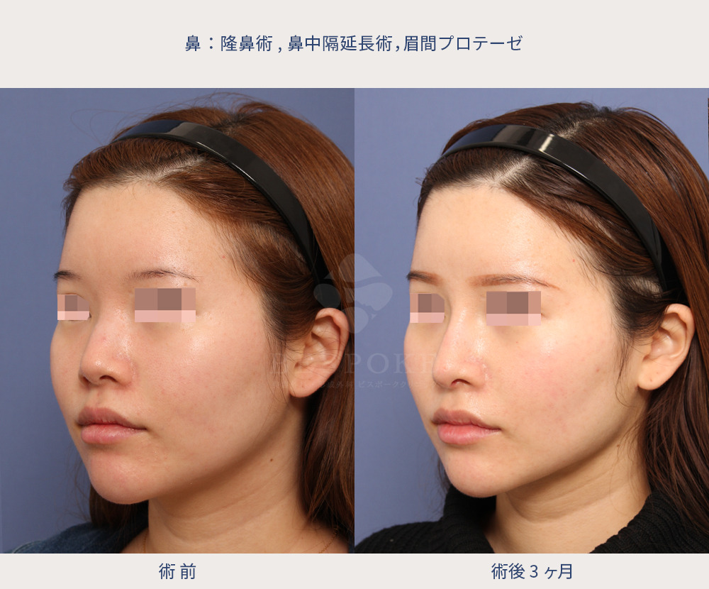 眉間プロテーゼ、隆鼻術、鼻中隔延長の症例