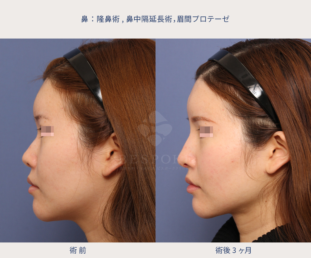 眉間プロテーゼ、隆鼻術、鼻中隔延長の症例