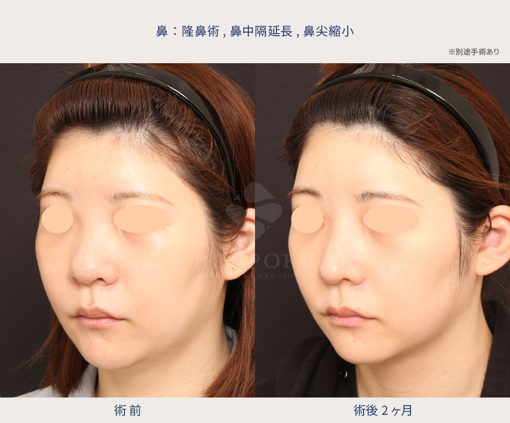 隆鼻術、鼻中隔延長、鼻尖縮小の症例