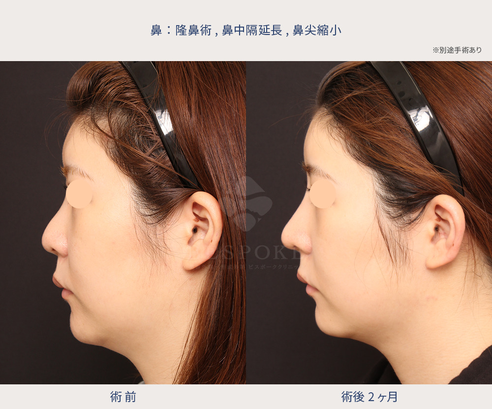 隆鼻術、鼻中隔延長、鼻尖縮小の症例