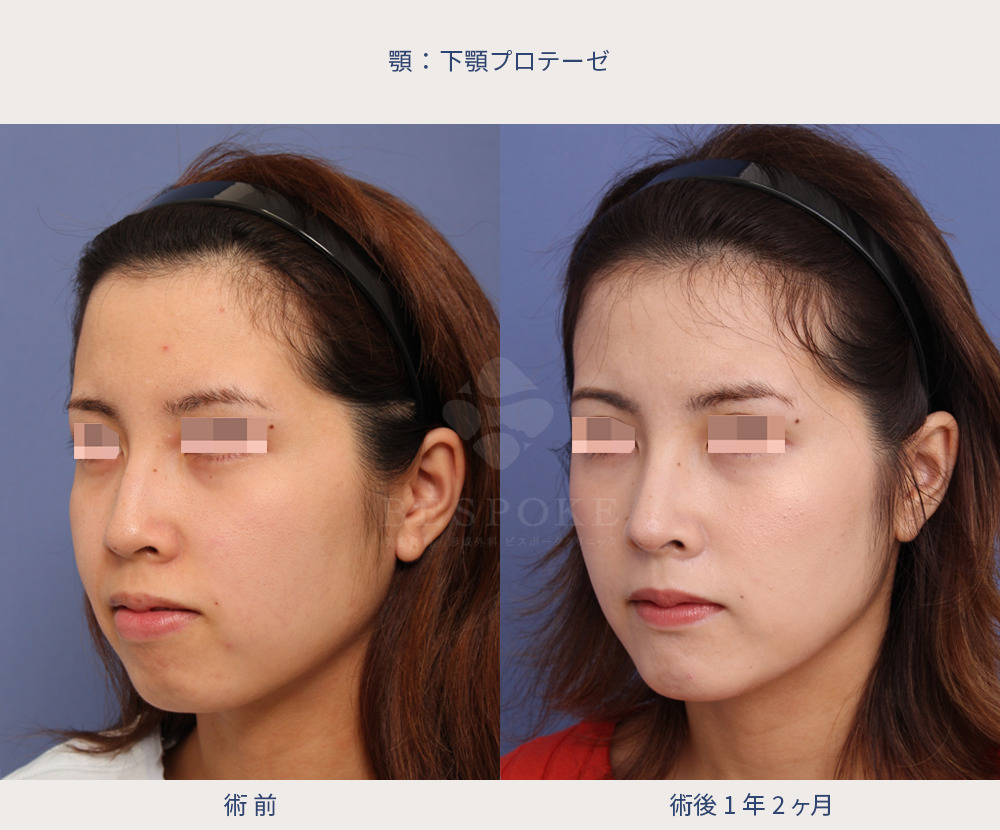 下顎プロテーゼ、隆鼻術、鼻中隔延長術、鼻尖縮小術の症例