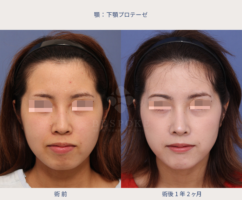 下顎プロテーゼ、隆鼻術、鼻中隔延長術、鼻尖縮小術の症例