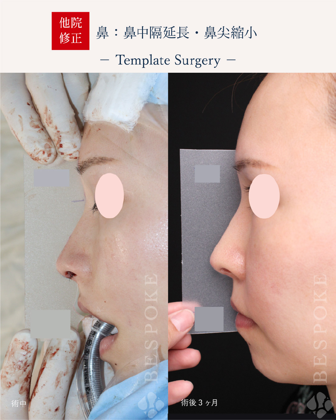 【テンプレートサージャリー】シミュレーションで作った鼻の形と、手術後の鼻の形の誤差を最小限に。鼻整形後の後戻りを研究 【テンプレートサージャリー】シミュレーションで作った鼻の形と、手術後の鼻の形の誤差を最小限に。鼻整形後の後戻りを研究
