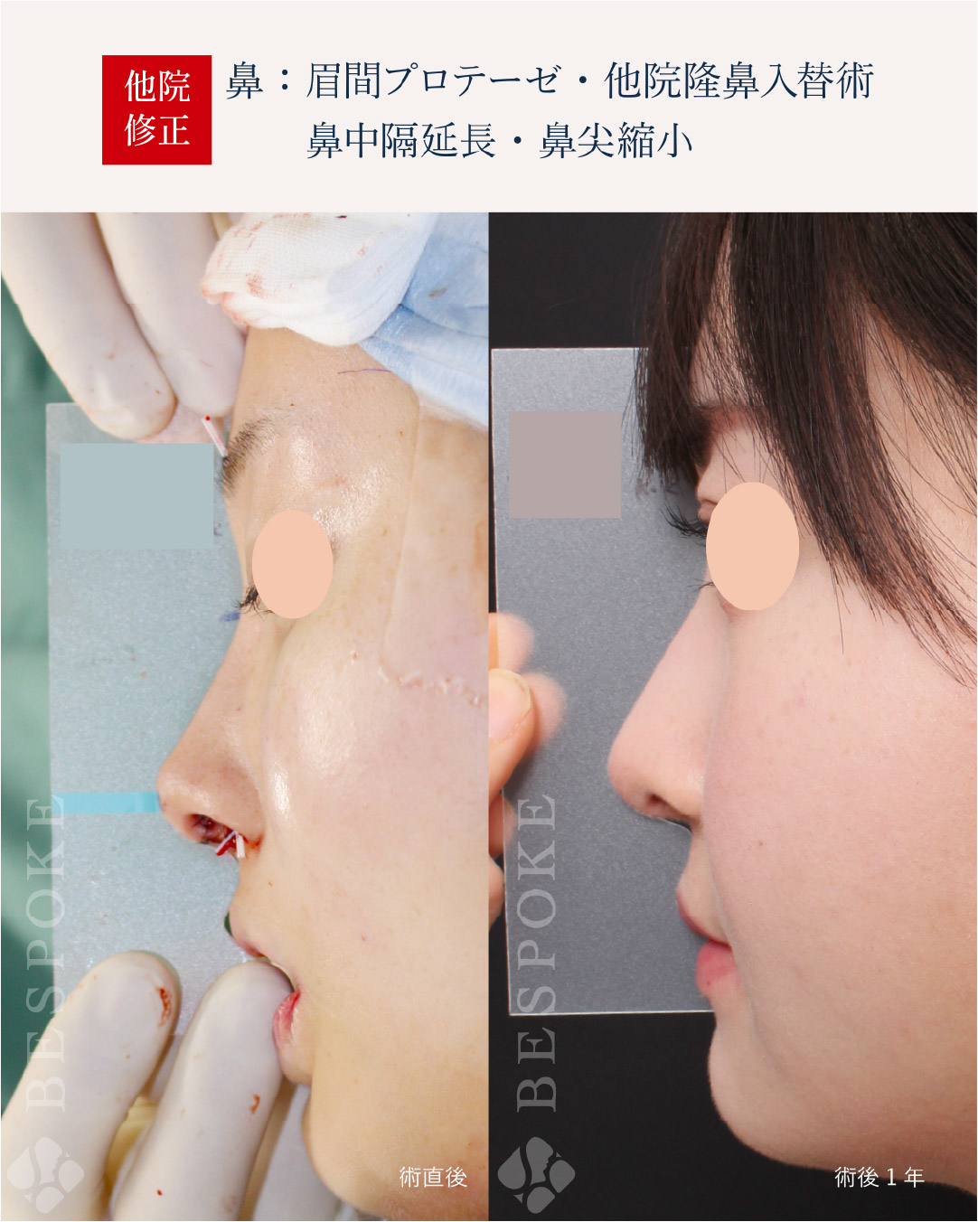 【テンプレートサージャリー】シミュレーションで作った鼻の形と、手術後の鼻の形の誤差を最小限に。鼻整形後の後戻りを研究 【テンプレートサージャリー】シミュレーションで作った鼻の形と、手術後の鼻の形の誤差を最小限に。鼻整形後の後戻りを研究