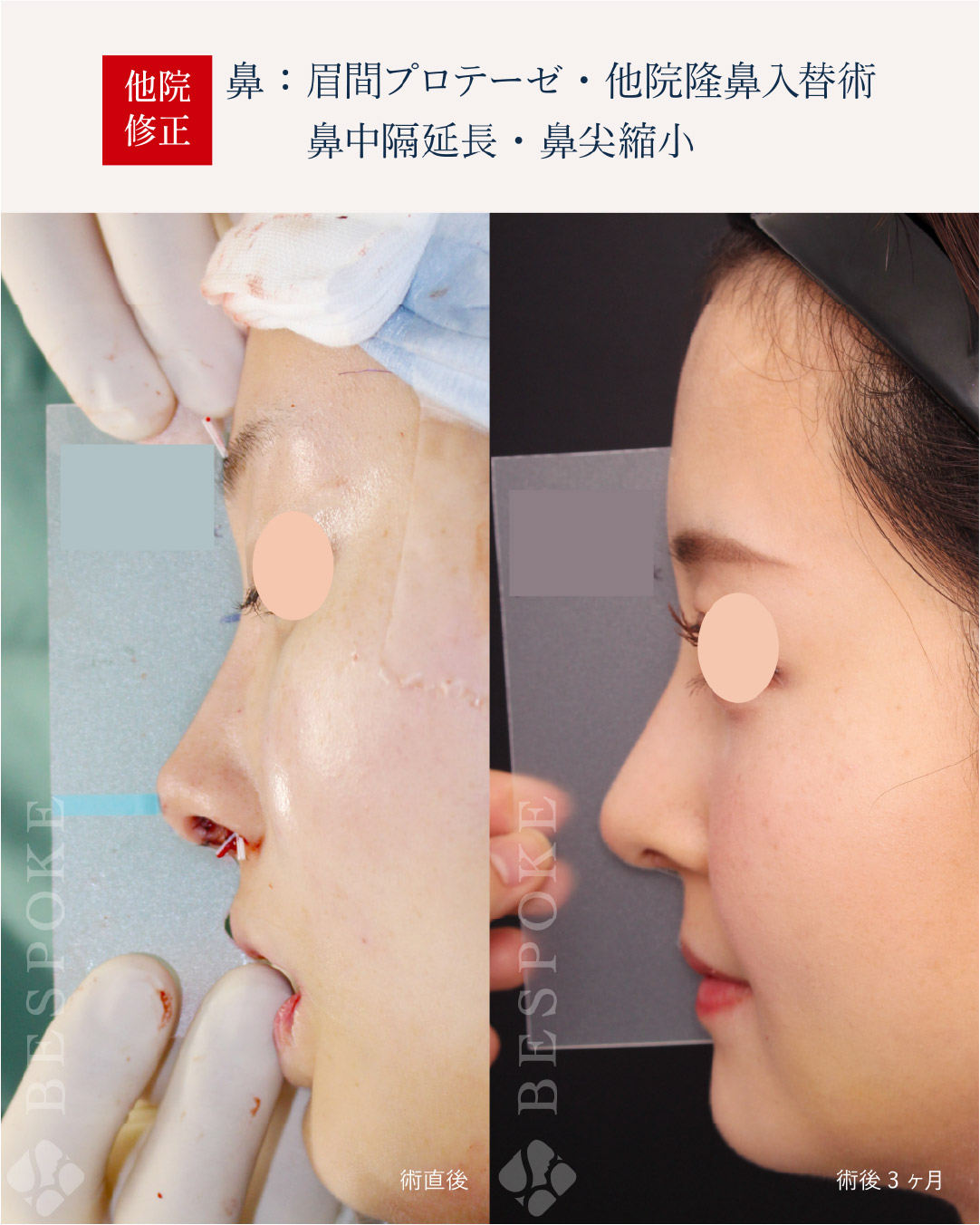 【テンプレートサージャリー】シミュレーションで作った鼻の形と、手術後の鼻の形の誤差を最小限に。鼻整形後の後戻りを研究 【テンプレートサージャリー】シミュレーションで作った鼻の形と、手術後の鼻の形の誤差を最小限に。鼻整形後の後戻りを研究