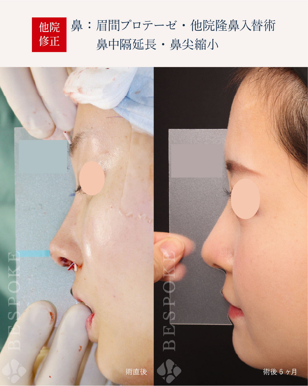 【テンプレートサージャリー】シミュレーションで作った鼻の形と、手術後の鼻の形の誤差を最小限に。鼻整形後の後戻りを研究 【テンプレートサージャリー】シミュレーションで作った鼻の形と、手術後の鼻の形の誤差を最小限に。鼻整形後の後戻りを研究