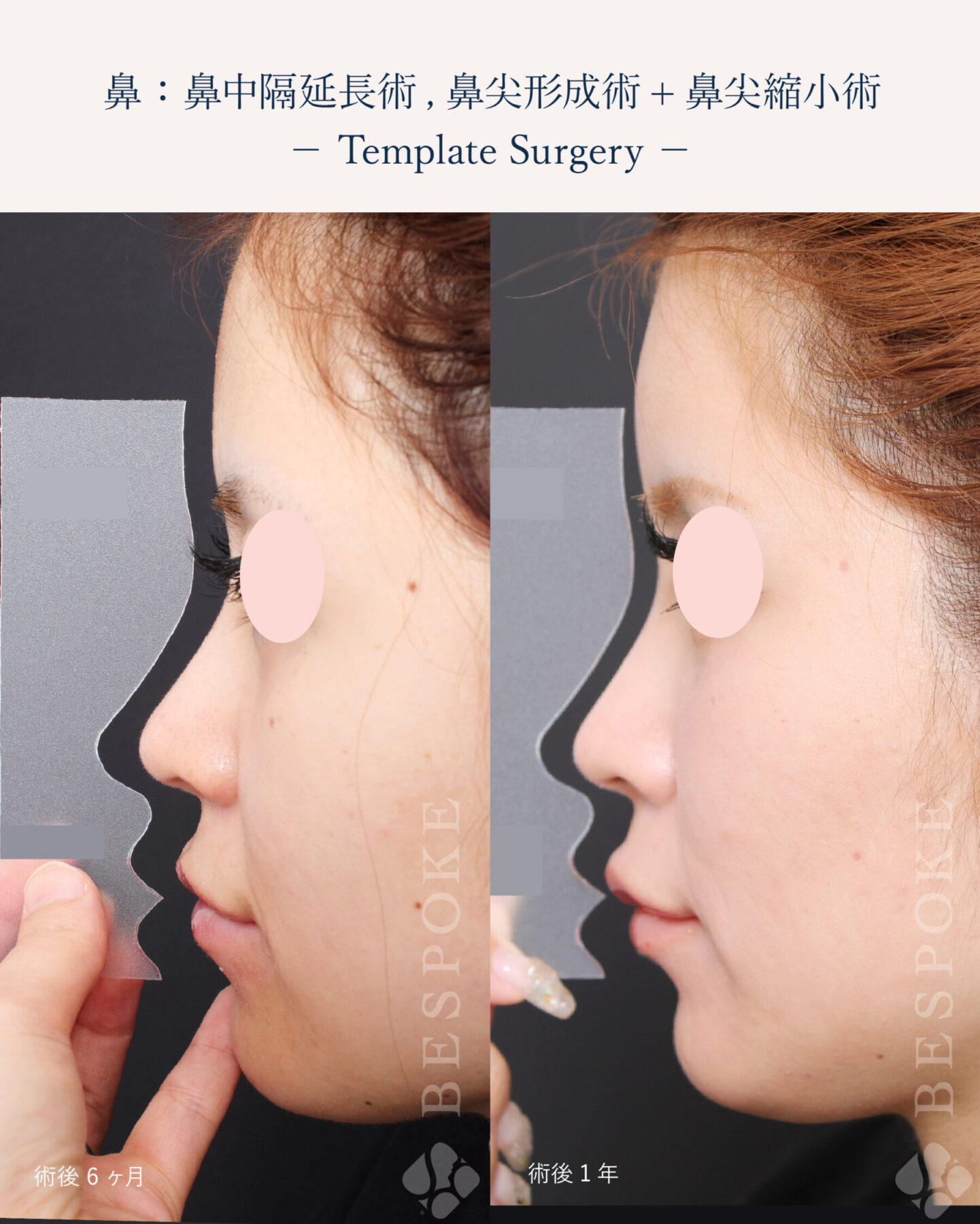 【テンプレートサージャリー】シミュレーションで作った鼻の形と、手術後の鼻の形の誤差を最小限に。鼻整形後の後戻りを研究 【テンプレートサージャリー】シミュレーションで作った鼻の形と、手術後の鼻の形の誤差を最小限に。鼻整形後の後戻りを研究