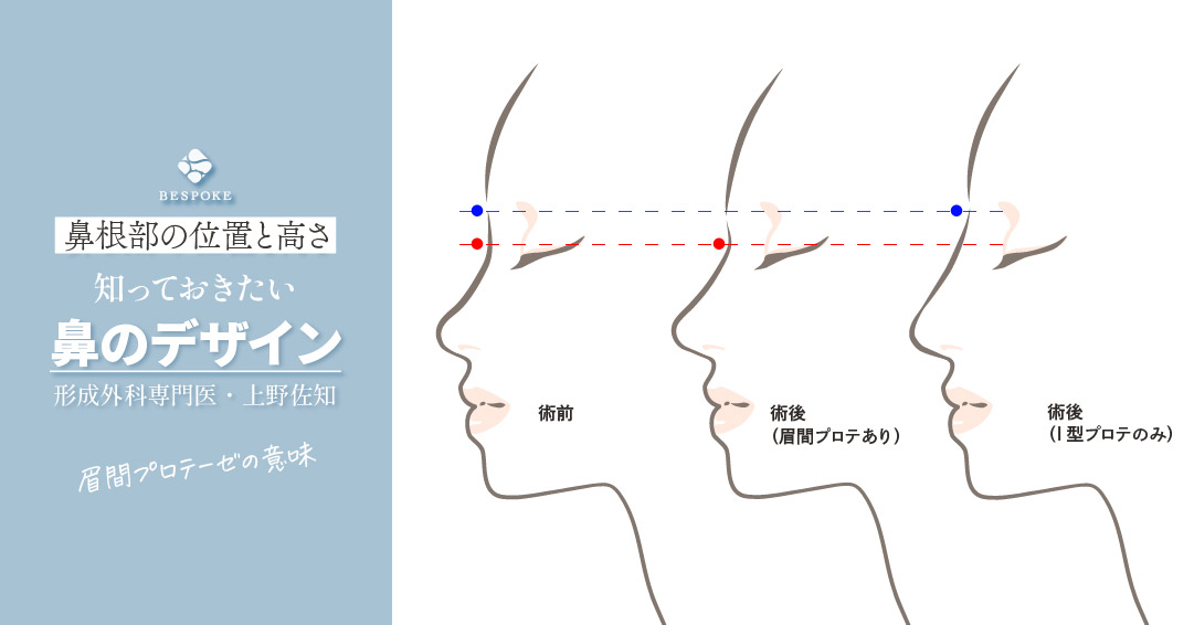 【知っておきたい鼻のデザイン】鼻根部の位置と高さ/眉間プロテーゼの意味