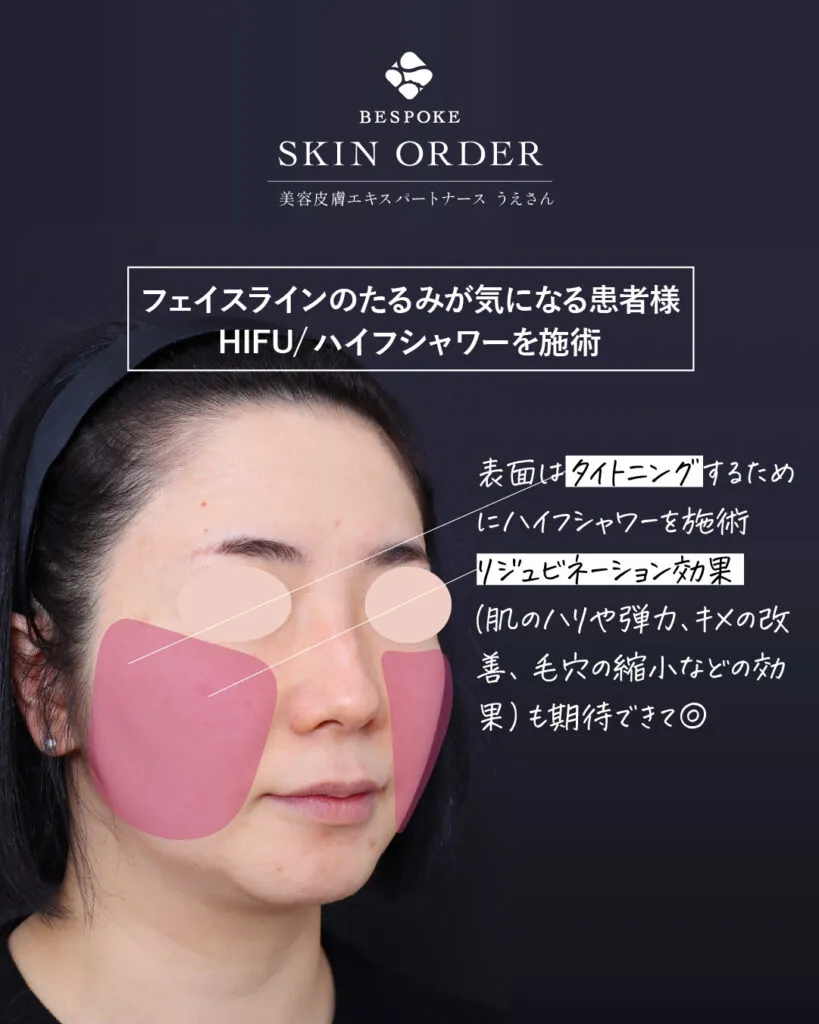 カスタマイズ肌治療（ビスポークオーダー）の症例