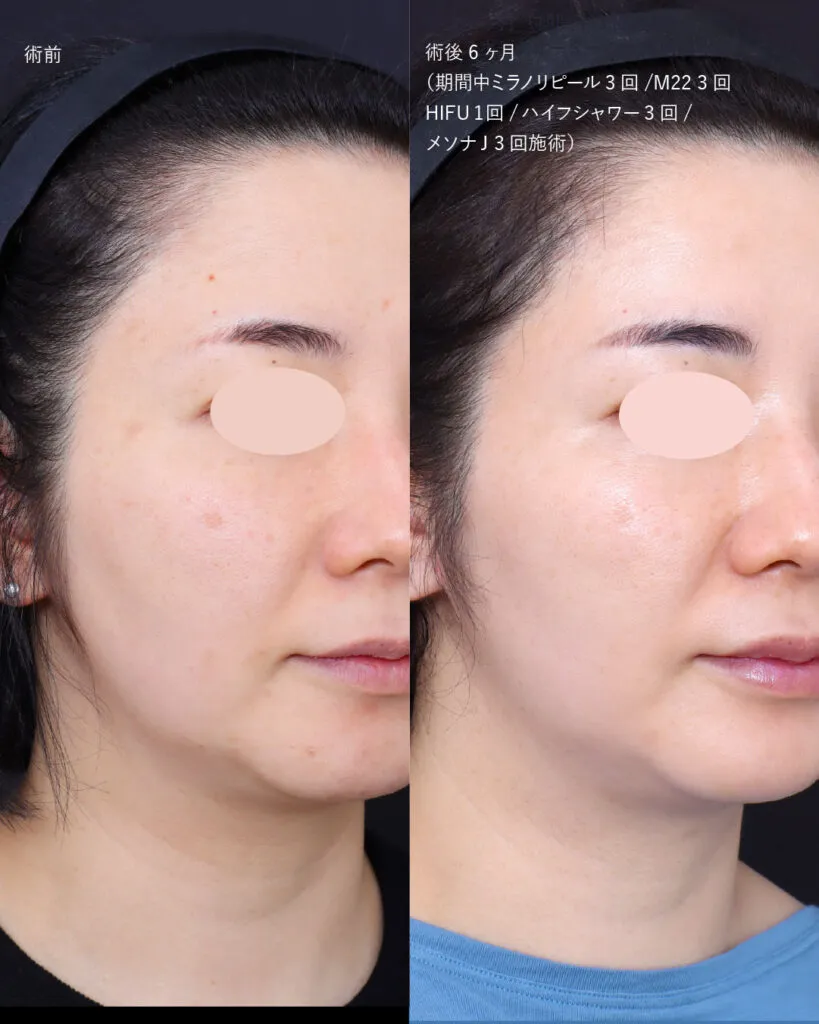 カスタマイズ肌治療の症例